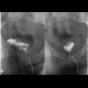 Crohn's disease, periproctal fistula communicating with rectum - fistulography: RF - Fluoroscopy